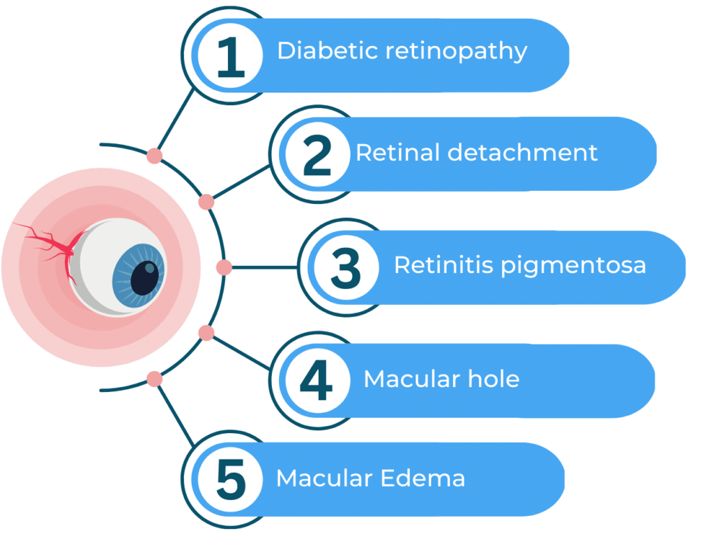 Most common diseases of the Retina