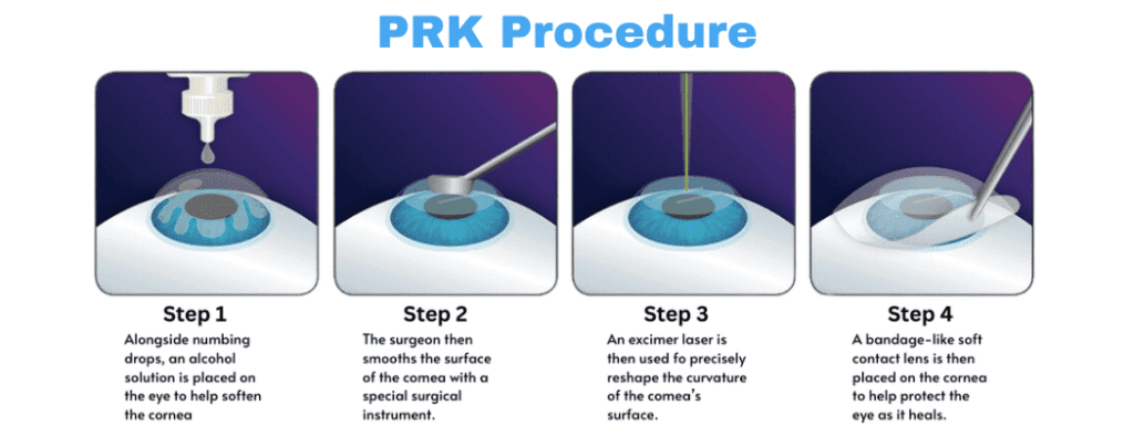 Photorefractive keratectomy (PRK)