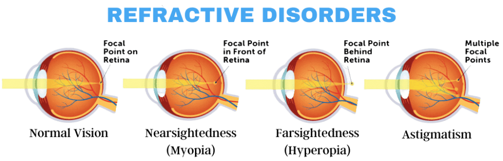refractive Errors