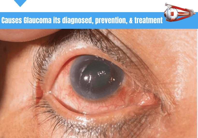 causes Glaucoma