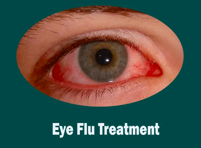 eye flu