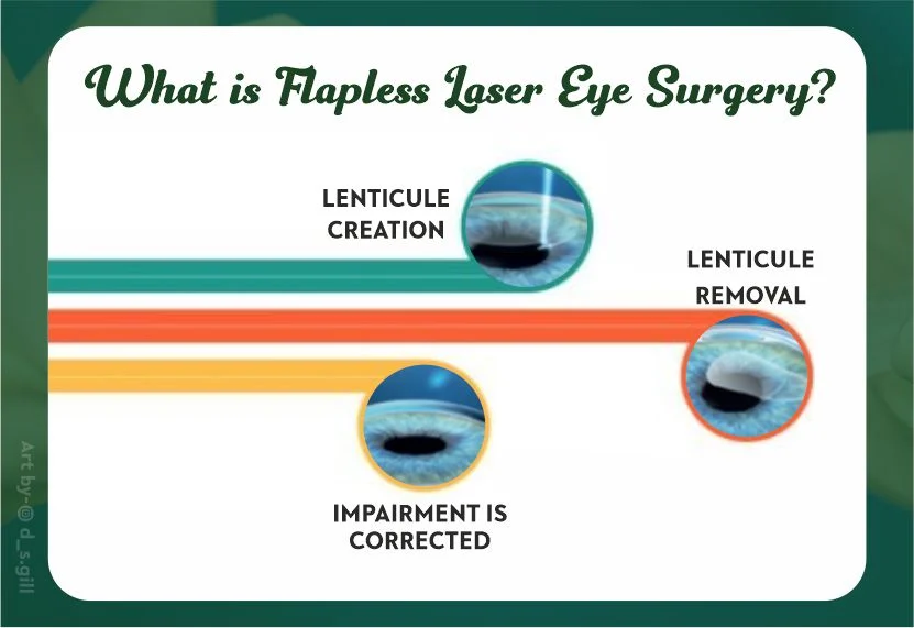 What is Flapless Laser Eye Surgery?